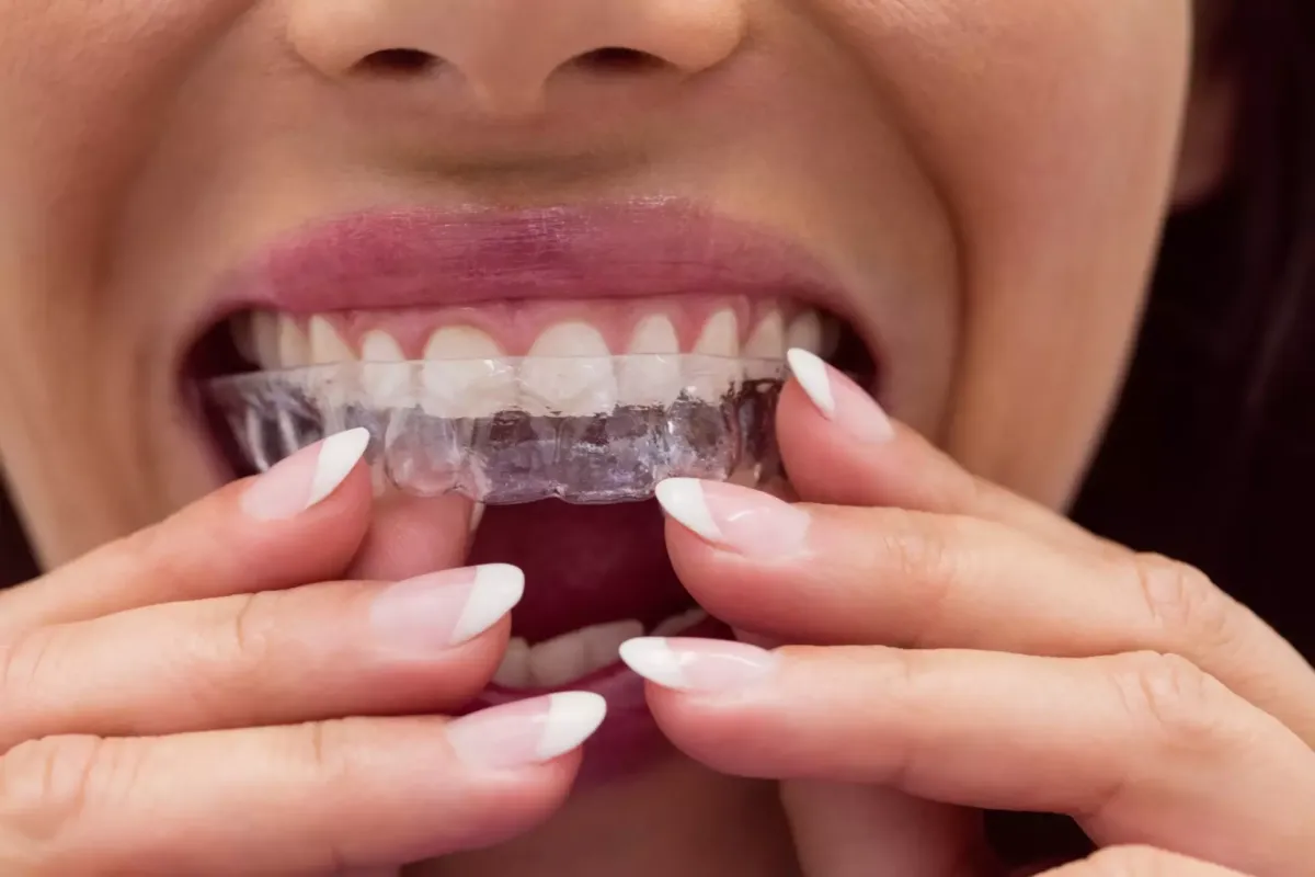 Mujer colocándose una férula de ortodoncia invisible