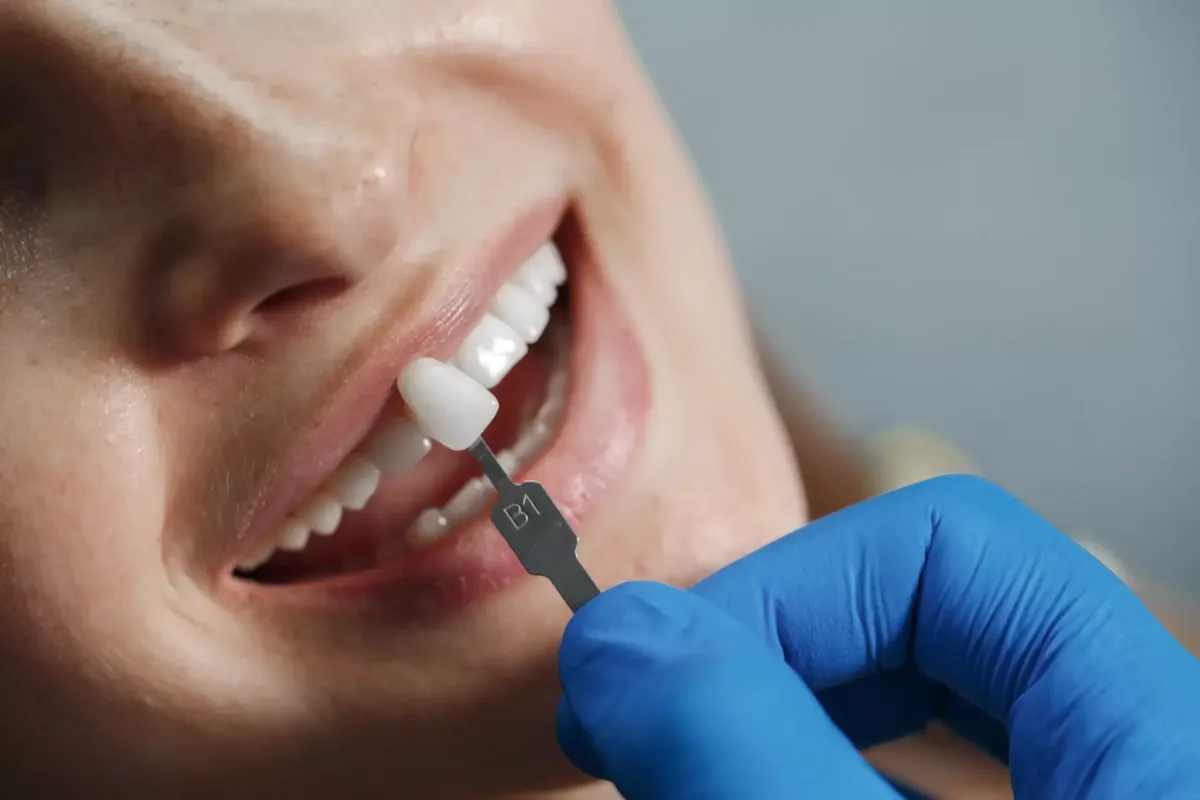 Comparando el tono de una prótesis dental con la dentadura